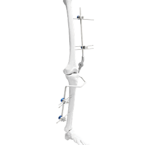 FIjador externo de rodilla (híbrido)