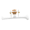 Sistema de transporte óseo transversal de la tibia