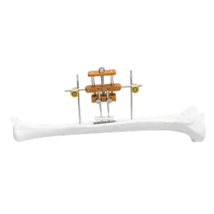 Sistema de transporte óseo transversal de la tibia