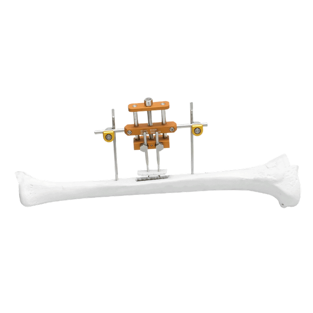 Sistema de transporte óseo transversal de la tibia