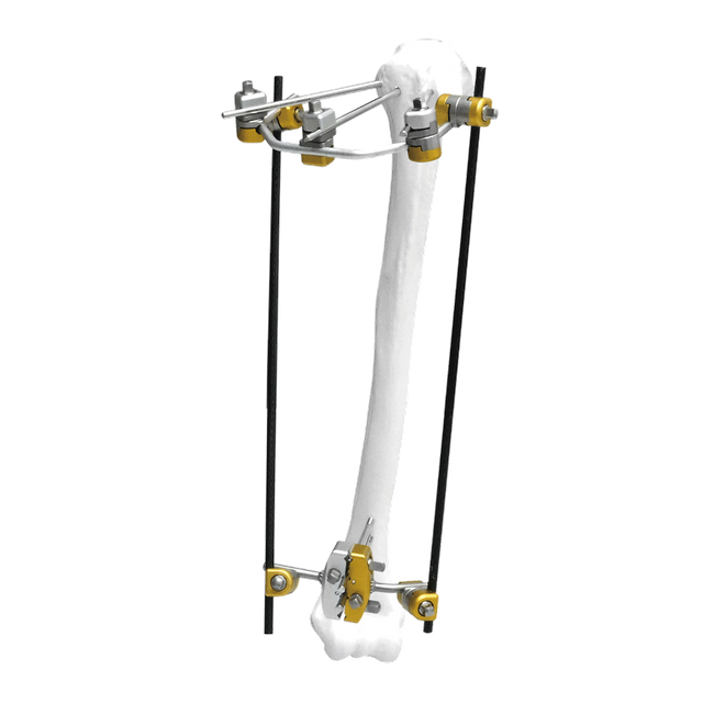 Fijador externo del húmero proximal