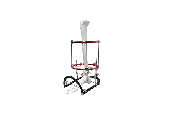 Equinus-Ilizarov-Fixator.jpg
