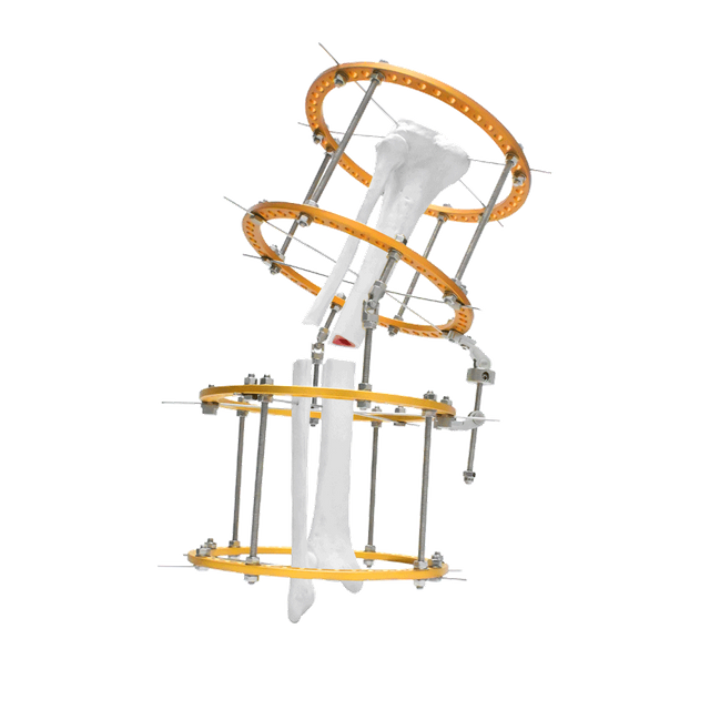 Fijador Vara Tibia Ilizarov