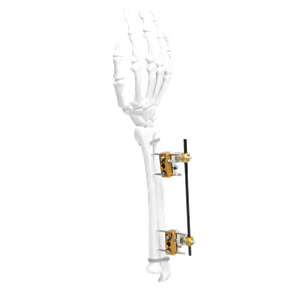 Fijador externo de cúbito y radio