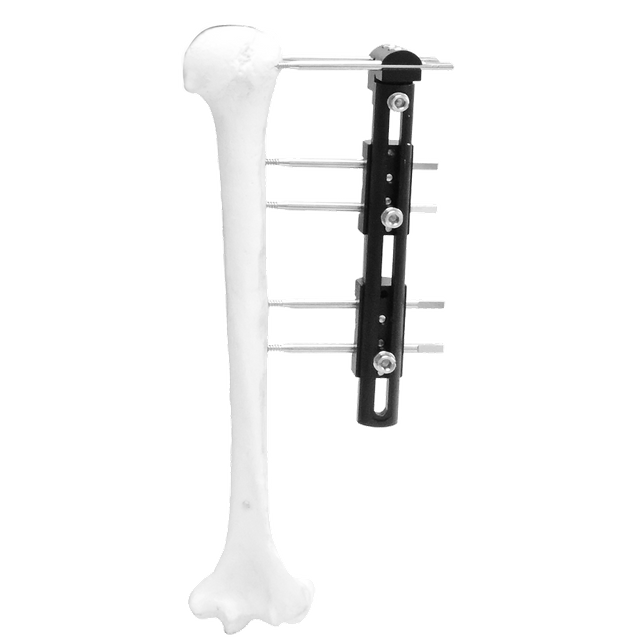 Fijador externo para reconstrucción pediátrica